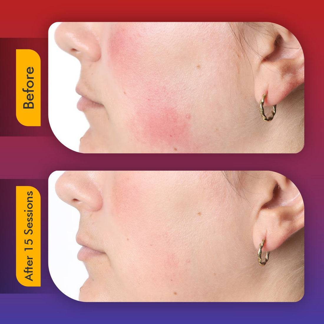 LumaSkin Pro 2.0 | LED Facial Mask