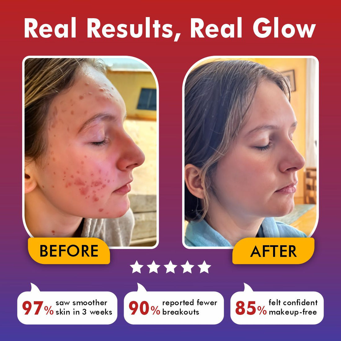 LumaSkin Pro 2.0 | LED Facial Mask